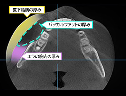 3D CT FIT 얼굴지방흡입