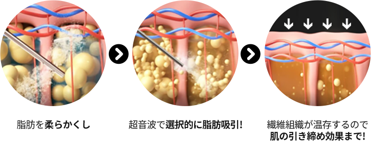 3D CT FIT 얼굴지방흡입