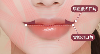 입꼬리성형
