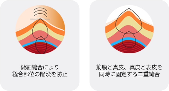 입꼭지성형