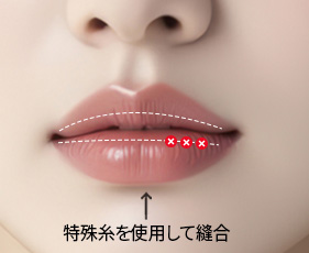 입술축소수술